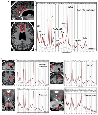 Metabolite Alterations in Adults With Schizophrenia, First Degree Relatives, and Healthy Controls: A Multi-Region 7T MRS Study